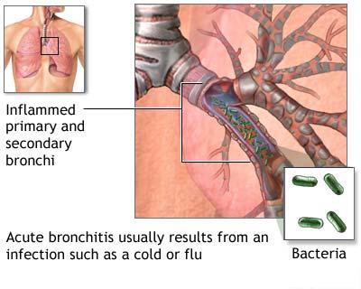 acute bronchitis